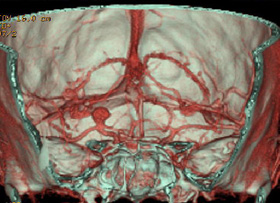 (三次元立体画像)動脈瘤