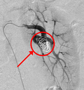 腎動脈瘤コイル塞栓後