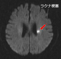 頭部MRI拡散強調画像（ラクナ梗塞）