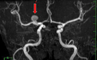 頭部MRA脳動脈瘤)