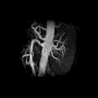 非造影腎動脈3DMRA