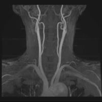非造影腎動脈MRA頸部MRA
