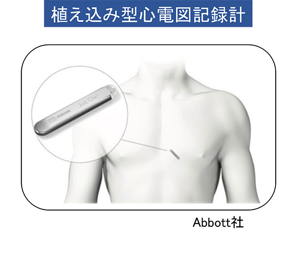 植え込み型心電図記録計（Abbott社）